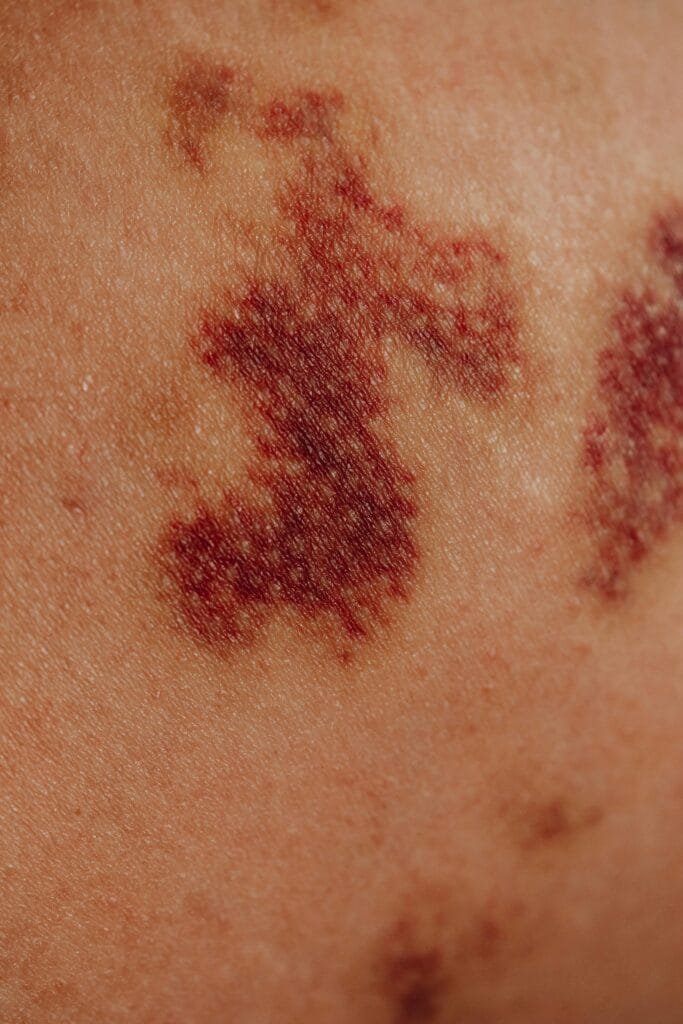 Detailed close-up view of bruising on skin, showing texture and color variations.